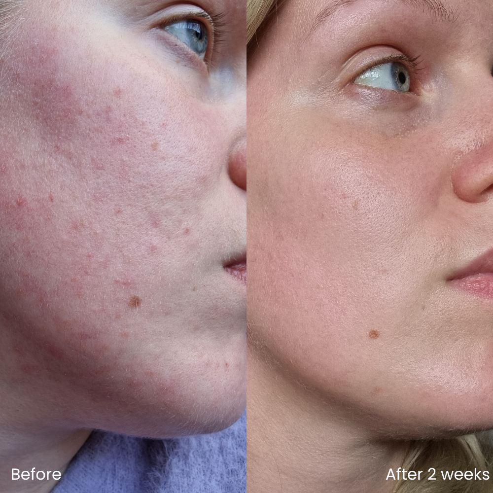Hyaluronic acid toner