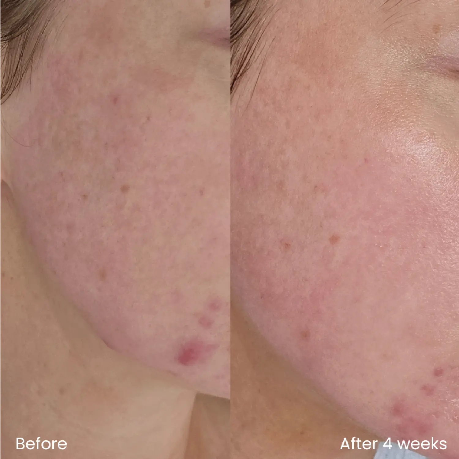 Hyaluronic acid bundle