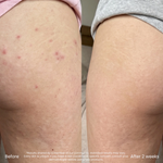 Soothing Body Lotion For Butt Pimples And Bumps