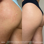 Soothing Body Lotion For Butt Pimples And Bumps